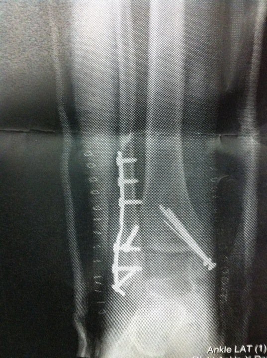 My ankle Xray